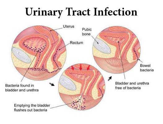Urinary Tract Infections UTIs in Adults
