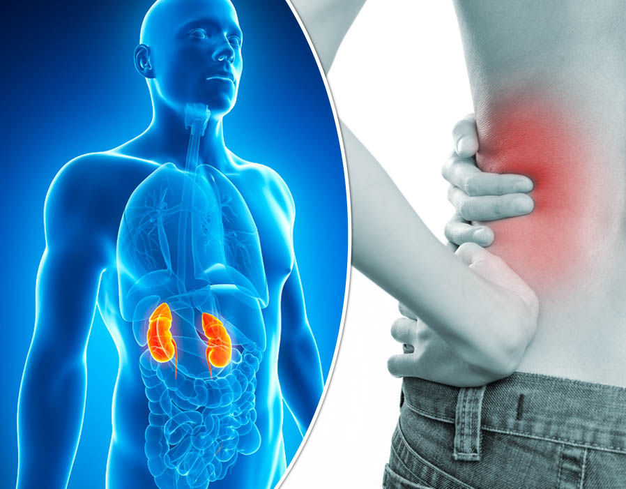 Ways To Prevent Kidney Stones