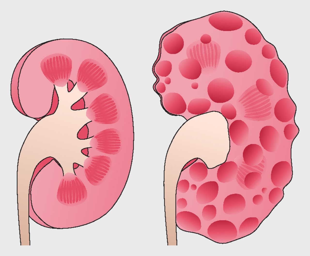 polycystic-kidney-disease-treatment-adult-pediatric-urology