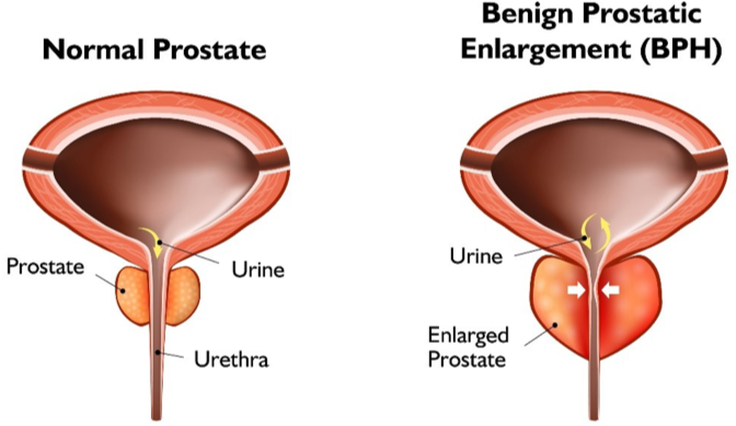 normal vs Benign Prostate BPH
